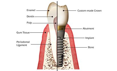 Fermín Mulas García implante dental 